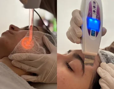 Alquimia da Pele: Uma Transformação Visível Já na Primeira Sessão